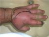 Swollen hand after Malaysian Hagen's Viper bit to the left index finger tip..jpg