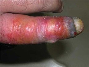 Hagen's Viper bite on left index finger2.jpg